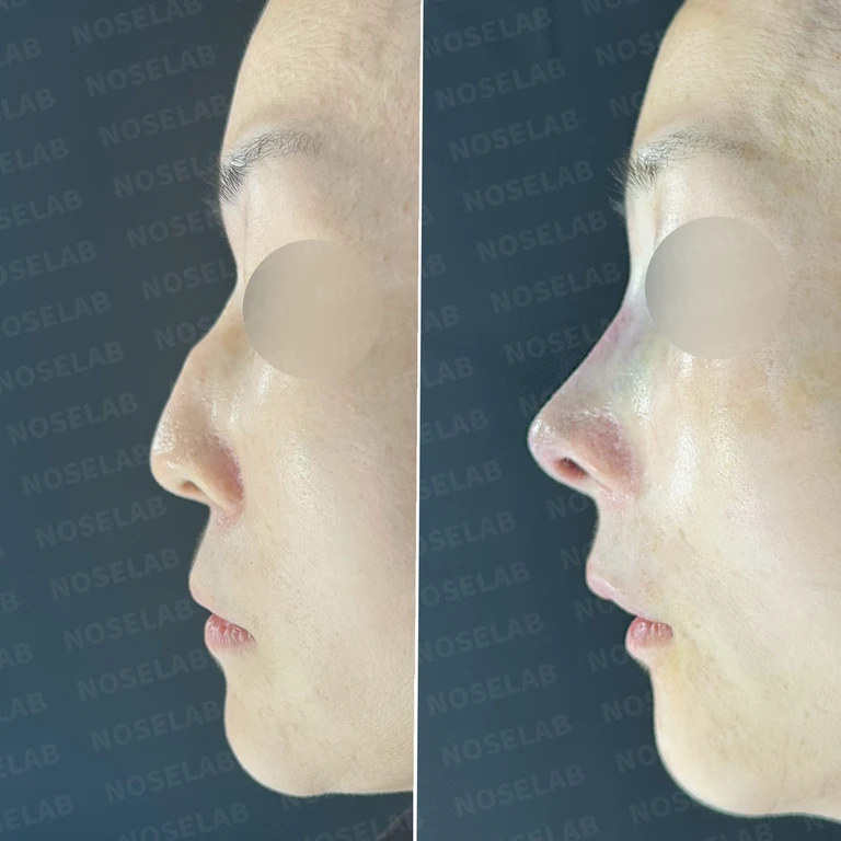 30년된 실리콘 피막 석회화로 생긴 매부리와 휜 코 교정 - 자가늑연골 재건 실제 후기 — 전후 비교