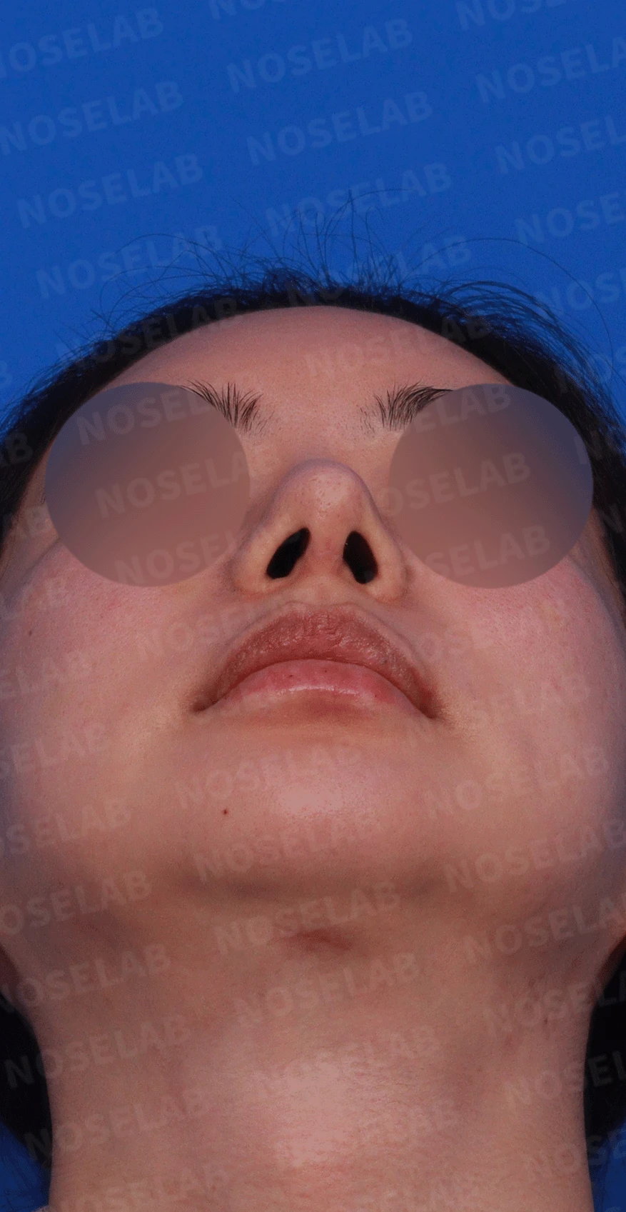 코가 과하게 높아져 부자연스러워 보이고 휘는 이유, 재건은 어떻게 하나 — 디자인 상담 우측 비스듬한 측면 , 측면 , 비공 사진입니다.
