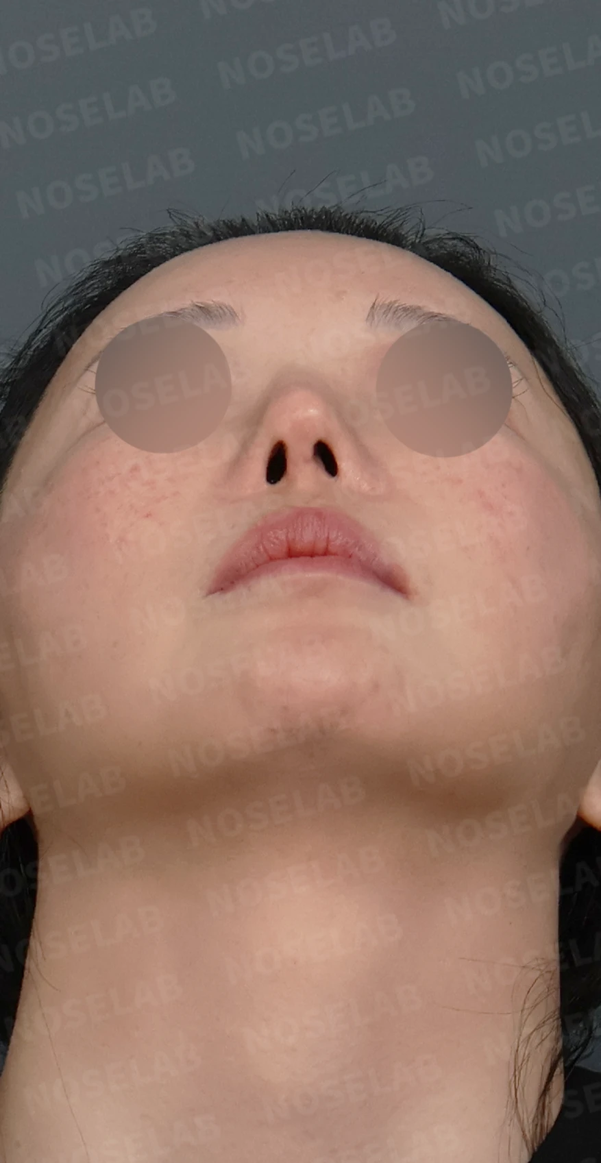 코성형 뒤 코막힘이 더 심해지는 이유, 비중격 재건과 절골 복원은 어떻게 하나 — 디자인 상담 우측 측면, 비스듬한 측면, 비공 사진입니다.