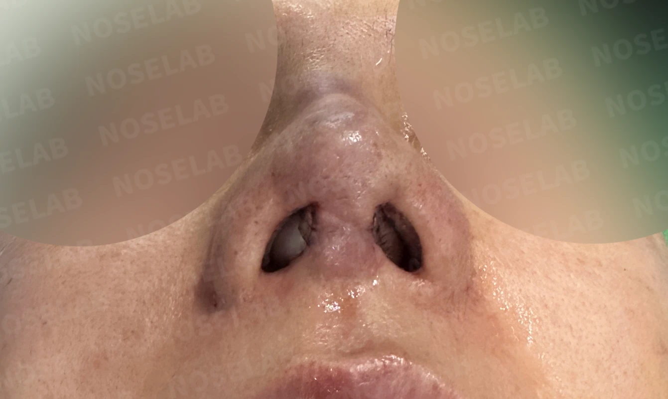 여러 차례 코재수술 후 구축 변형, 자가늑연골로 재건한 사례 — 직후 비공 사진입니다.