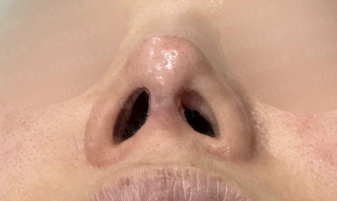 코끝 피부가 얇아져 연골이 비치는 이유, 피부 보강은 어떻게 하나 — 수술 전 / 수술 직후 0일 직후 사진은 부기가 있는 상태로 최종 결과와 다를 수 있습니다.