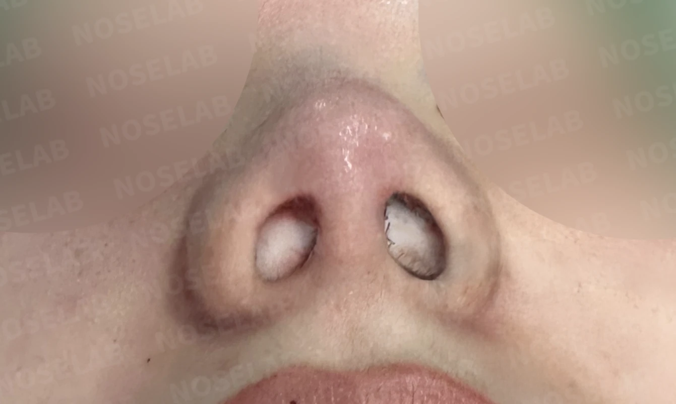 복코와 들린 코끝, 자가늑연골로 여성스러운 직반라인 완성 — 직후 비공 사진입니다.
