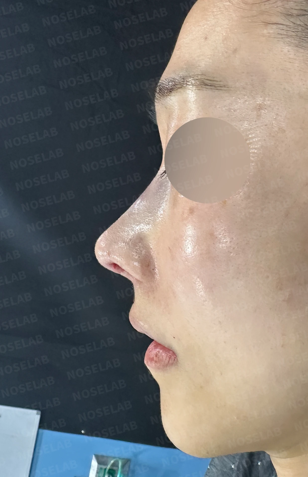 비중격 연골이 약해진 코, 보형물 없이 재건하는 방법 — 수술 전 / 수술 직후 0일 직후 사진은 부기가 있는 상태로 최종 결과와 다를 수 있습니다.