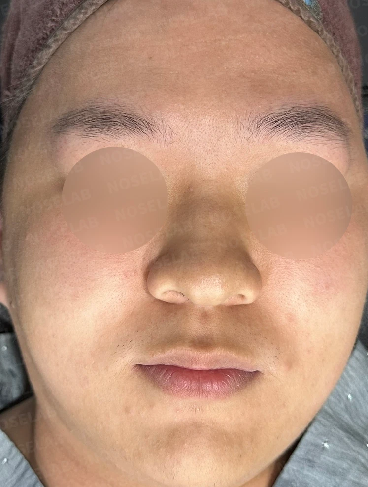 코막힘과 복코를 함께 살펴보는 교정 방법 — 수술 전 / 수술 직후 0일 직후 사진은 부기가 있는 상태로 최종 결과와 다를 수 있습니다.