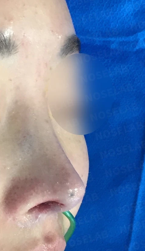 매부리코와 코끝의 비개방 교정 방법 — 본문 사진 4