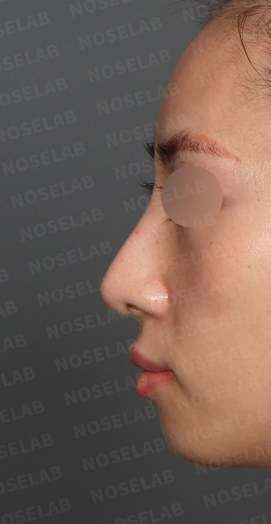 자가 늑연골 코재수술, 콧대부터 코끝까지 슬림하고 여성스럽게 — 디자인 상담 정면, 좌측 측면, 비스듬한 측면 사진 입니다.