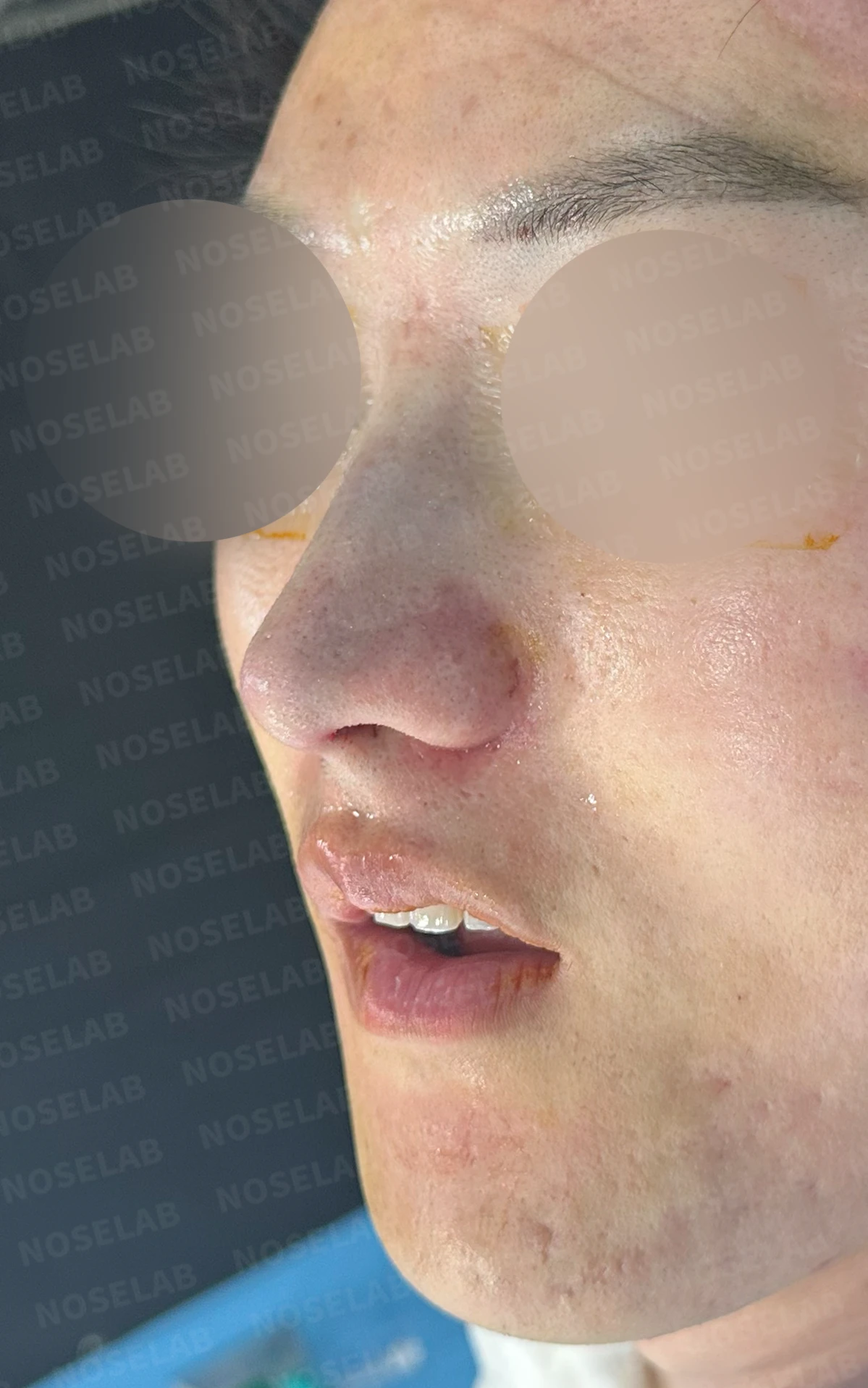 보형물 없이 코끝과 경계 부분만 교정하는 방법 — 수술 직후 0일 정면 , 측면 , 비스듬한 측면 사진 직후 사진은 부기가 있는 상태로 최종 결과와 다를 수 있습니다.