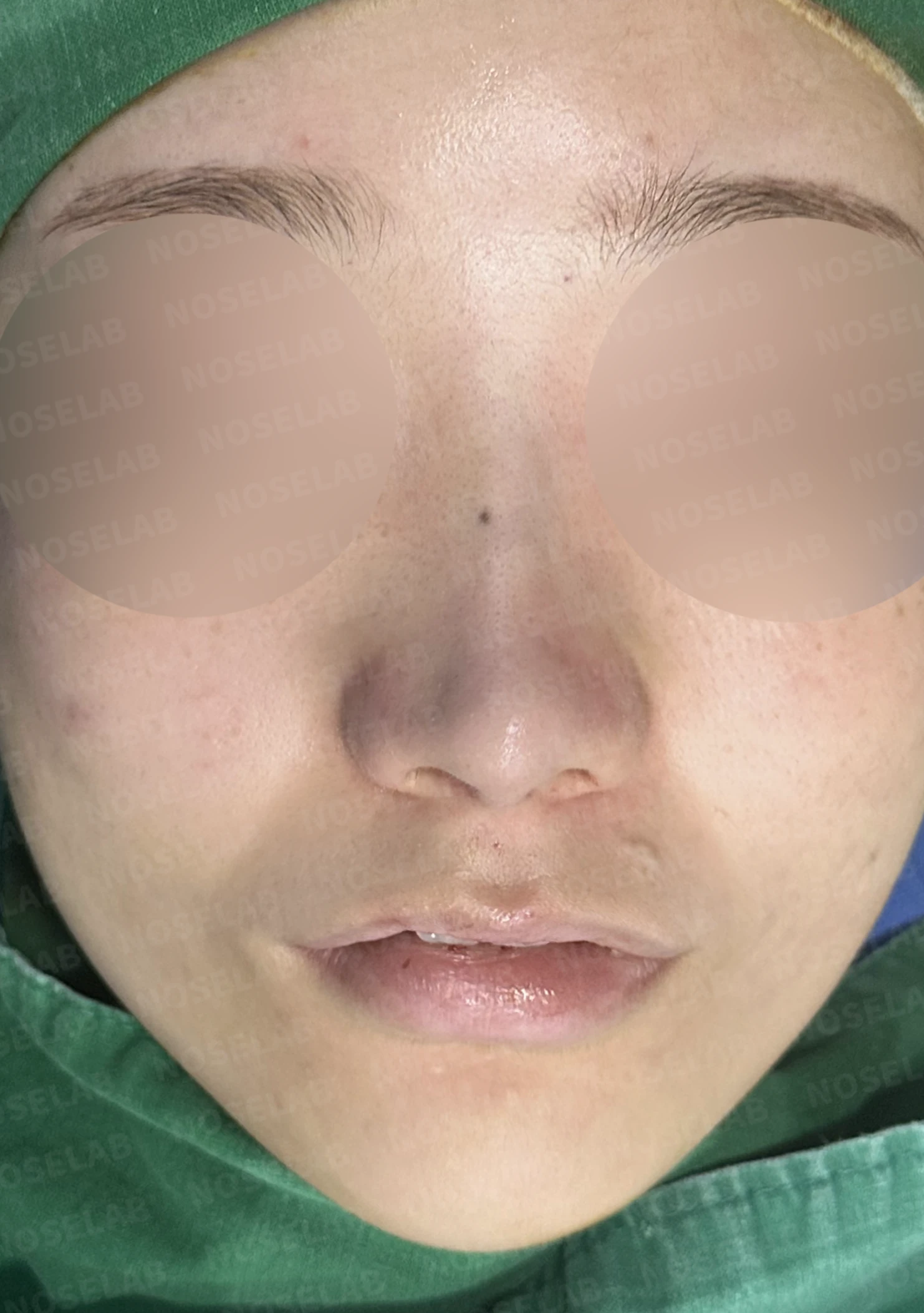 연골 노출 복원과 날개 연골 재건으로 안전하고 자연스러운 코 — 전(좌) , 직후(후)
