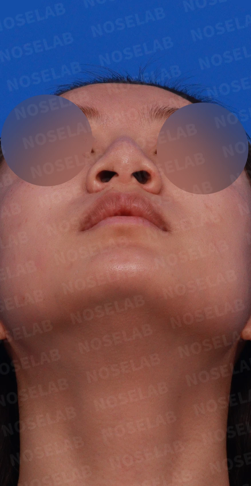 복코와 퍼진 코, 처진 코끝이 함께 오는 이유와 슬림한 라인을 만드는 방법 — 디자인 상담 우측 비스듬한 측면, 측면, 비공 사진