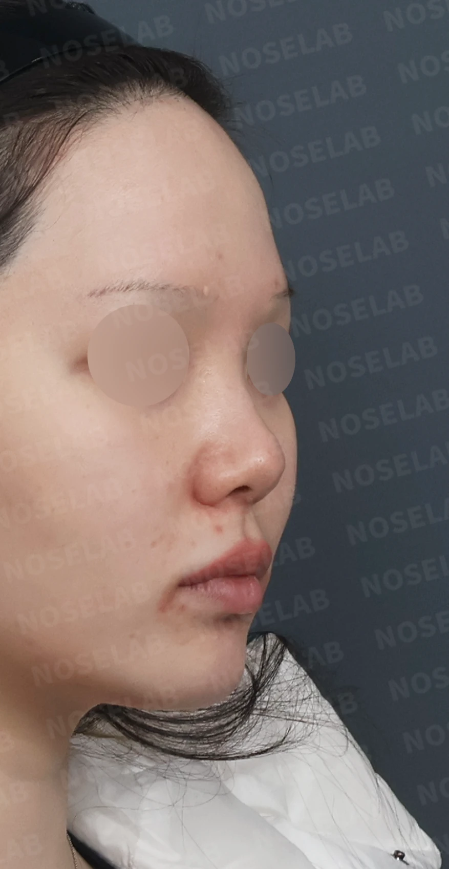 복코와 들린 코끝, 자가늑연골로 여성스러운 직반라인 완성 — 디자인 상담 우측 측면, 비스듬한 측면, 비공 사진입니다.