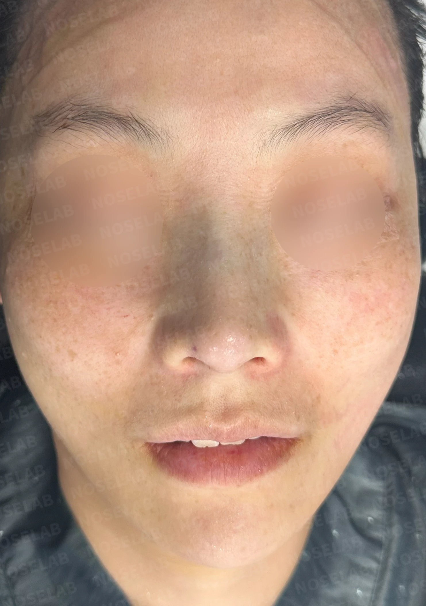 첫 코성형에서 코끝 구조와 콧구멍 노출은 어떻게 다루나 — 수술 전 / 수술 직후 0일 직후 사진은 부기가 있는 상태로 최종 결과와 다를 수 있습니다.