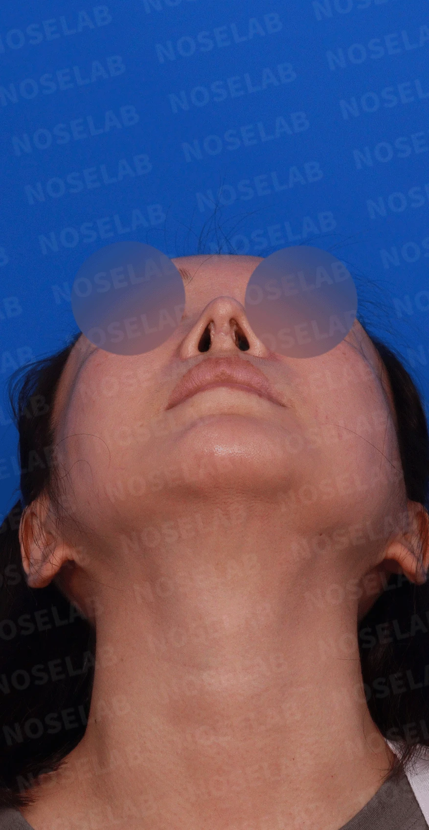 반복된 코재수술 뒤 안장코와 비밸브 협착이 생기는 이유, 전체 재건은 어떻게 하나 — 디자인 상담 우측 비스듬한 측면 , 측면 , 비공 사진입니다.