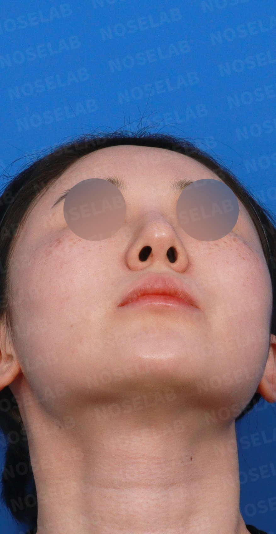 길고 뭉툭한 코, 자가늑연골로 화려하면서 자연스럽게 — 디자인 상담 우측 측면, 비스듬한 측면, 비공 사진입니다.