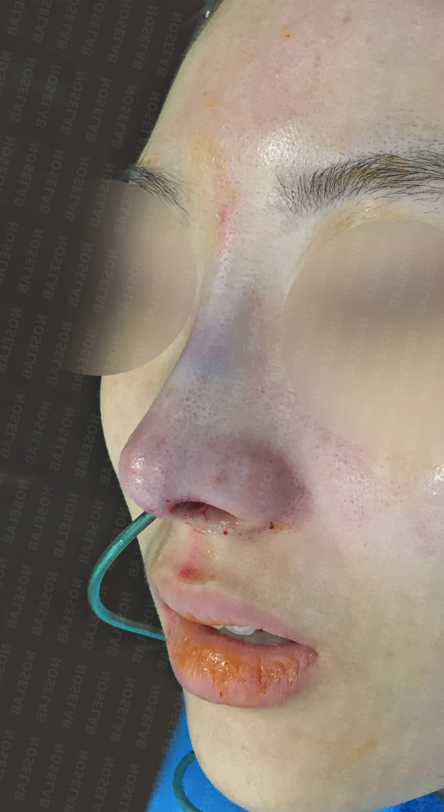 매부리코에 코의 휨과 비공 비대칭이 함께 오는 이유, 비중격 연골 교정은 어떻게 하나 — 수술 직후 0일 정면, 측면, 비스듬한 측면 직후 사진은 부기가 있는 상태로 최종 결과와 다를 수 있습니다.