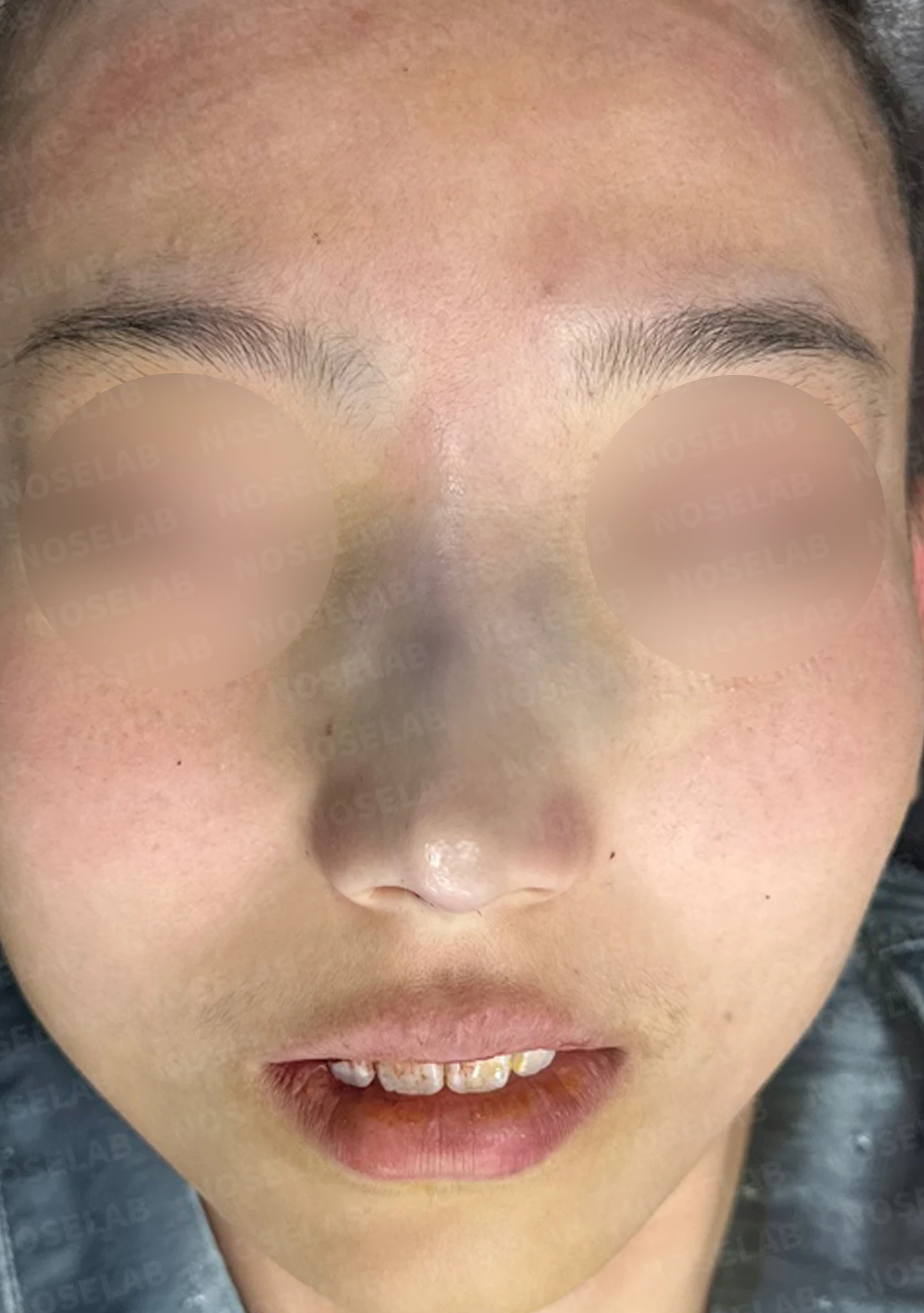 외상 뒤 심해진 매부리와 휜 코, 변화를 최소로 두는 교정 방법 — 본문 사진 15