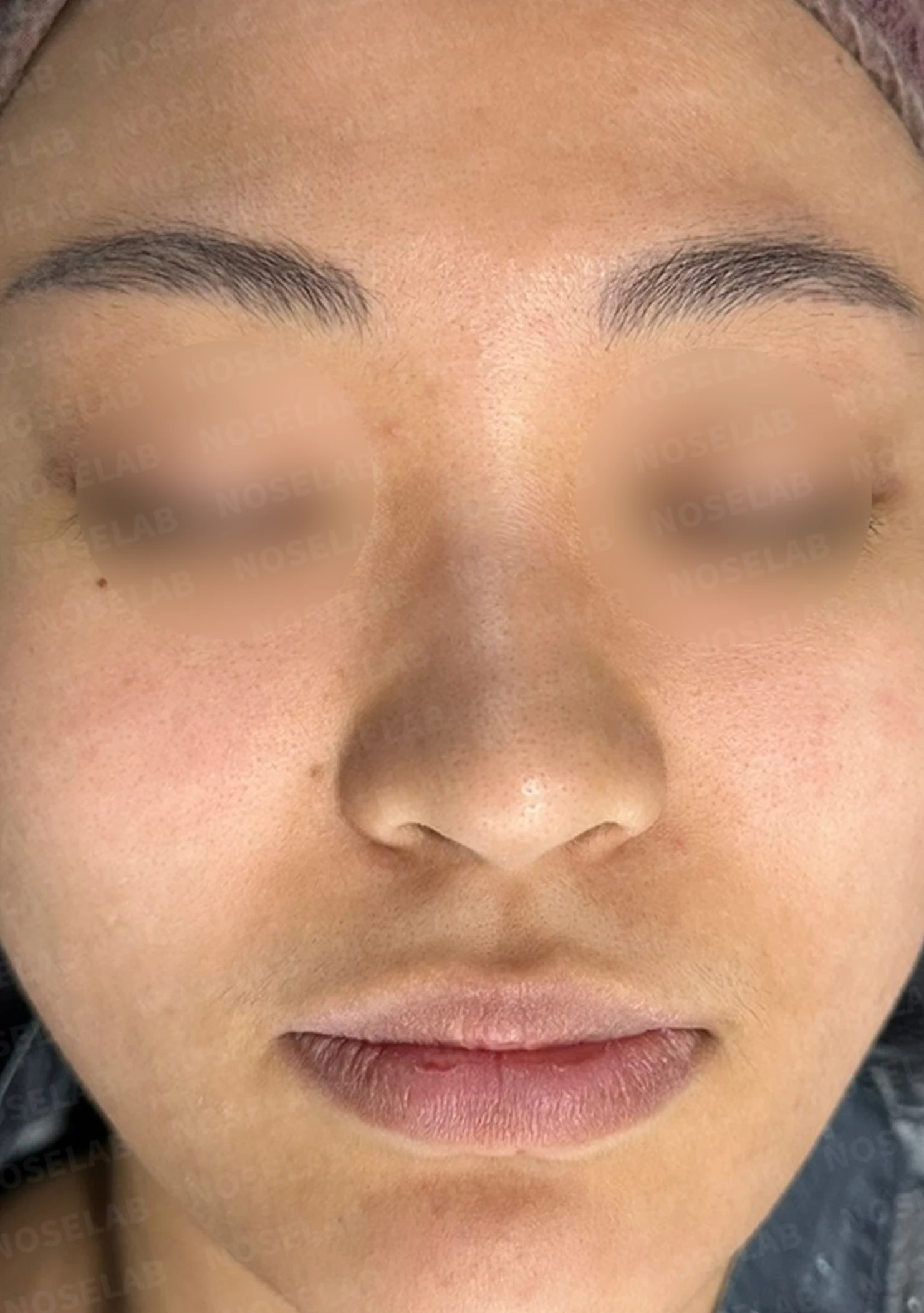 뭉툭하게 퍼진 코끝이 생기는 이유, 자가 늑연골 비중격 연장으로 직반 라인을 만드는 방법 — 수술 전 / 수술 직후 0일 직후 사진은 부기가 있는 상태로 최종 결과와 다를 수 있습니다.