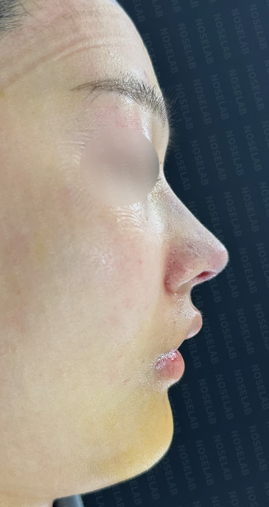 찝혀 올라간 콧구멍 교정 방법 — 수술 직후 0일 사진 정면, 비스듬한 측면, 측면 직후 사진은 부기가 있는 상태로 최종 결과와 다를 수 있습니다.
