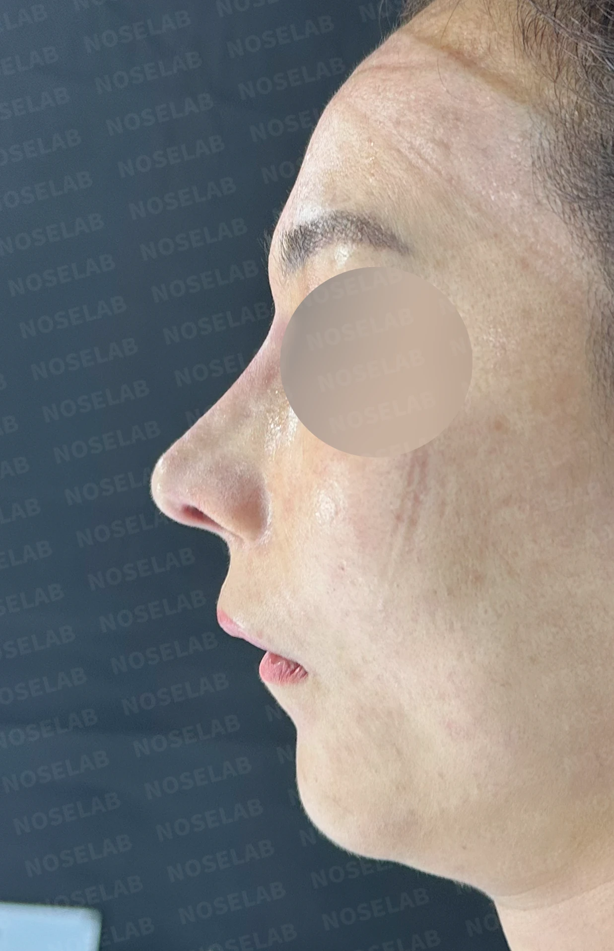 무자격 불법 주사 뒤 콧구멍이 좁아지는 이유와 제거·재건 방법 — 수술 직후 0일 정면, 측면, 비스듬한 측면 사진 직후 사진은 부기가 있는 상태로 최종 결과와 다를 수 있습니다.