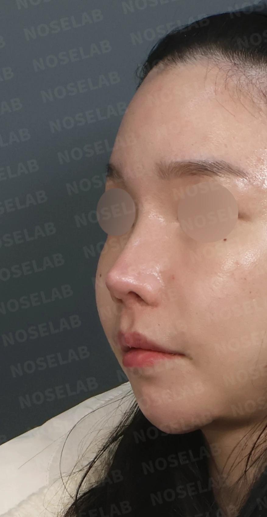 들린코와 비공 비대칭, 기증늑연골로 정교하게 교정한 코재수술 — 디자인 상담 정면, 좌측 측면, 비스듬한 측면 사진입니다.
