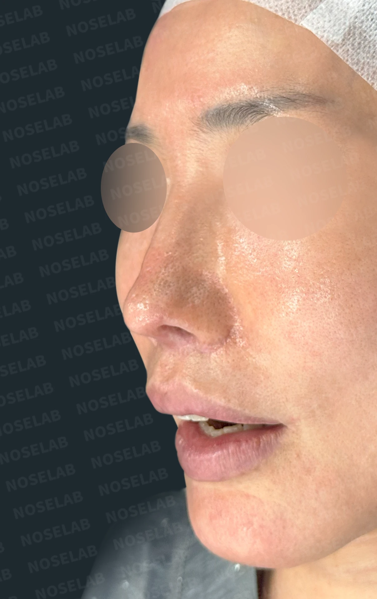 여러 차례 수술 뒤 비중격이 손상되면, 늑연골 재건은 어떻게 하나 — 수술 전 / 수술 직후 0일 직후 사진은 부기가 있는 상태로 최종 결과와 다를 수 있습니다.