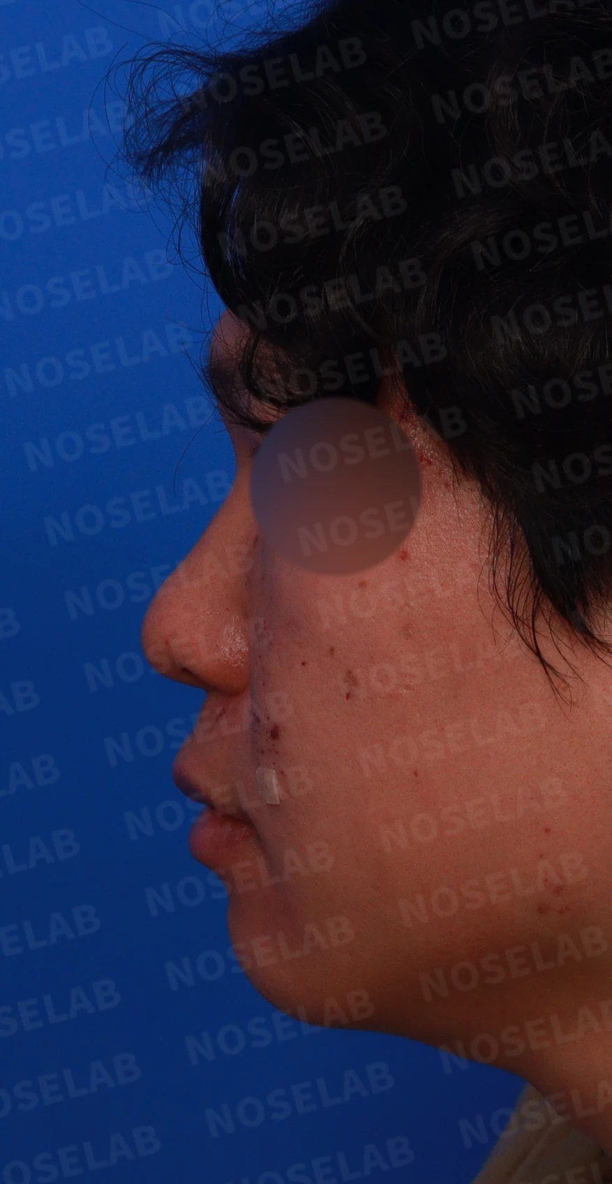 얼굴 비율을 고려한 코성형과 무턱 교정 방법 — 디자인 상담 정면, 좌측 측면, 비스듬한 측면 사진입니다.