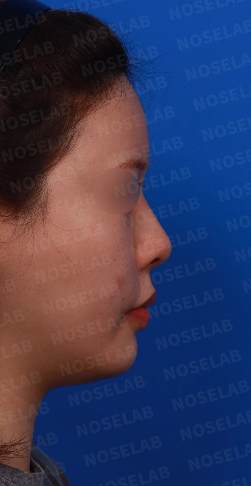고개를 들면 콧구멍 모양이 다르고 코가 막히는 이유, 비중격 재건 방법 — 디자인 상담 우측 측면 , 비스듬한 측면 , 비공 사진입니다.
