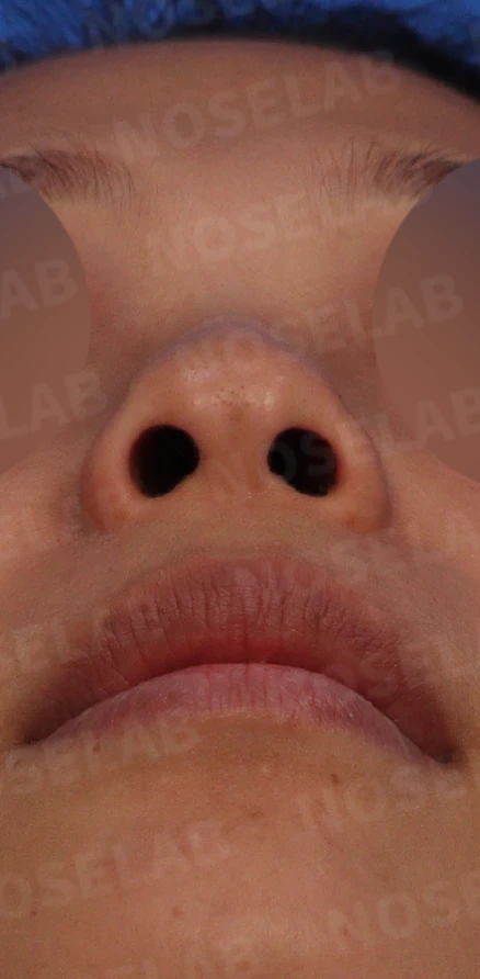 갈라져 보이는 코끝의 구조와 교정 방법 — 본문 사진 4