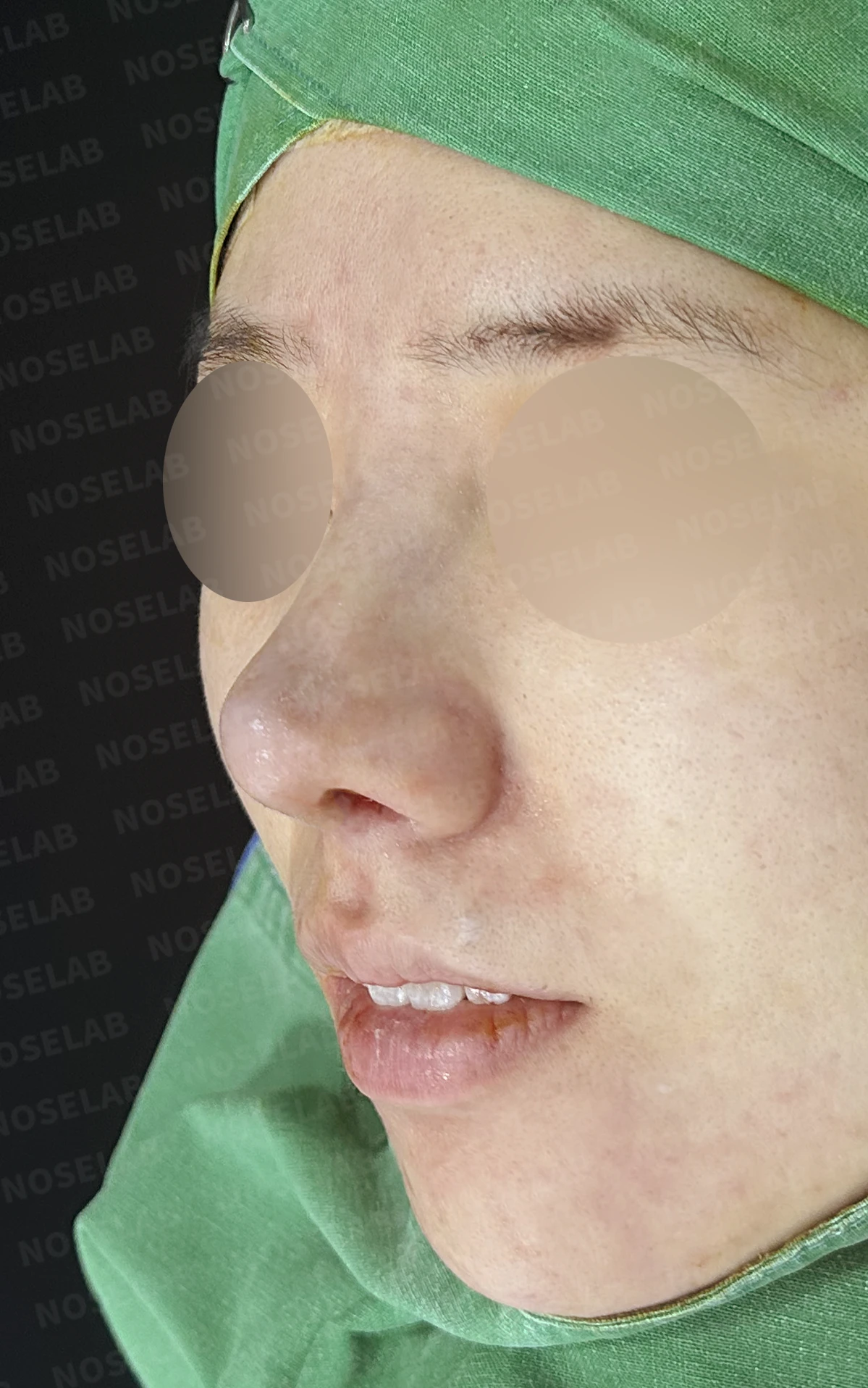 이전 수술 뒤 코가 딱딱해지고 짧아지는 구축, 왜 생기고 어떻게 재건하나 — 수술 직후 0일 정면, 비스듬한 측면, 측면 사진입니다. 직후 사진은 부기가 있는 상태로 최종 결과와 다를 수 있습니다.