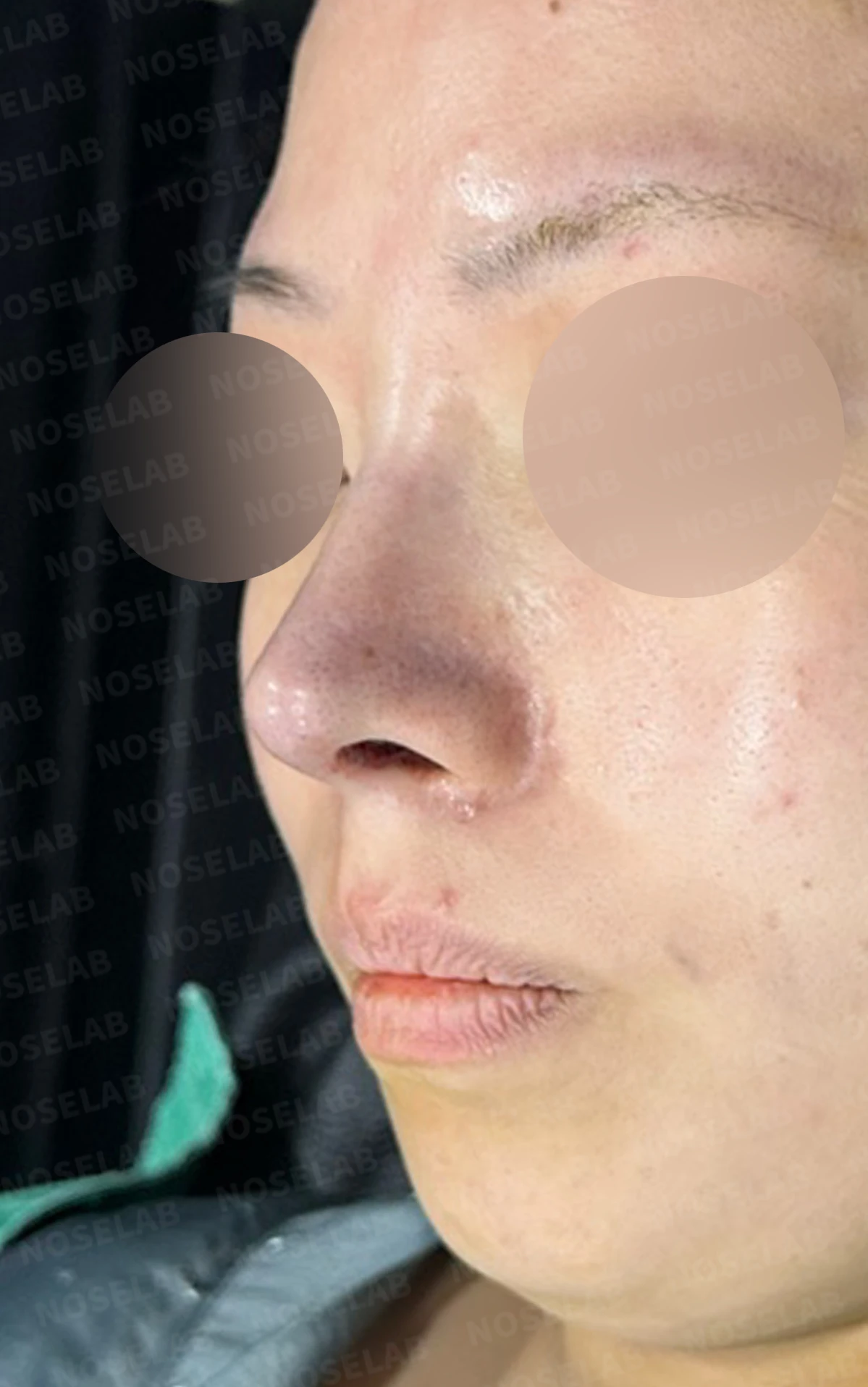 재수술 뒤에도 복코와 퍼진 코끝이 남는 이유, 자가 늑연골 재건은 어떻게 하나 — 수술 전 / 수술 직후 0일 직후 사진은 부기가 있는 상태로 최종 결과와 다를 수 있습니다.
