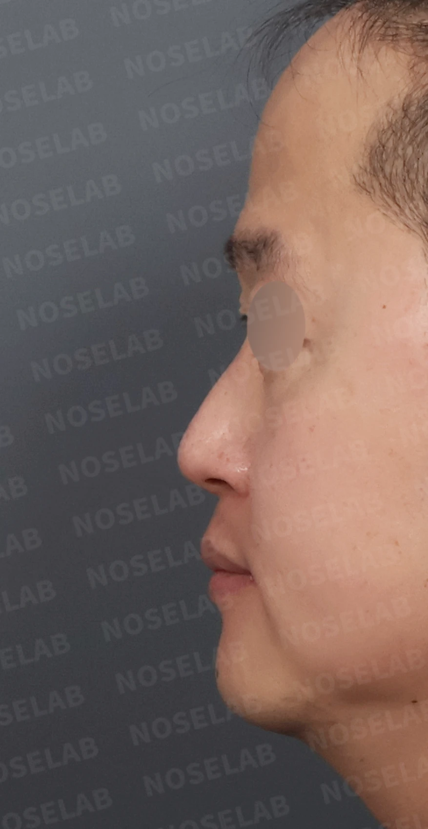 코막힘과 휘어진 비중격, 자가늑연골로 기능과 모양을 동시에 개선 — 디자인 상담 정면, 좌측 측면, 비스듬한 측면 사진입니다.