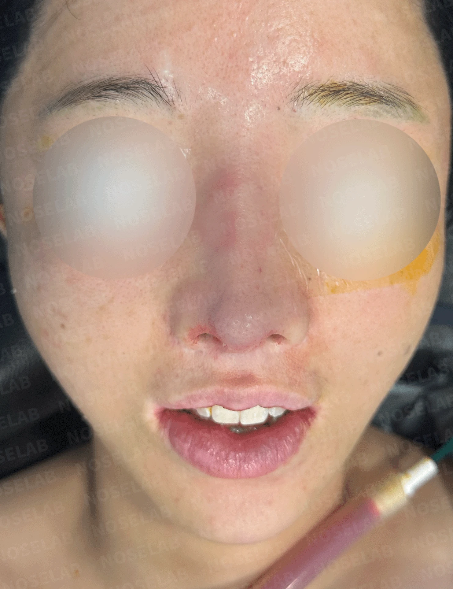 다수 재수술 후 인공진피 흡수와 비중격 손상 재건 사례 — 직후 정면 , 측면 , 비스듬한 측면 사진