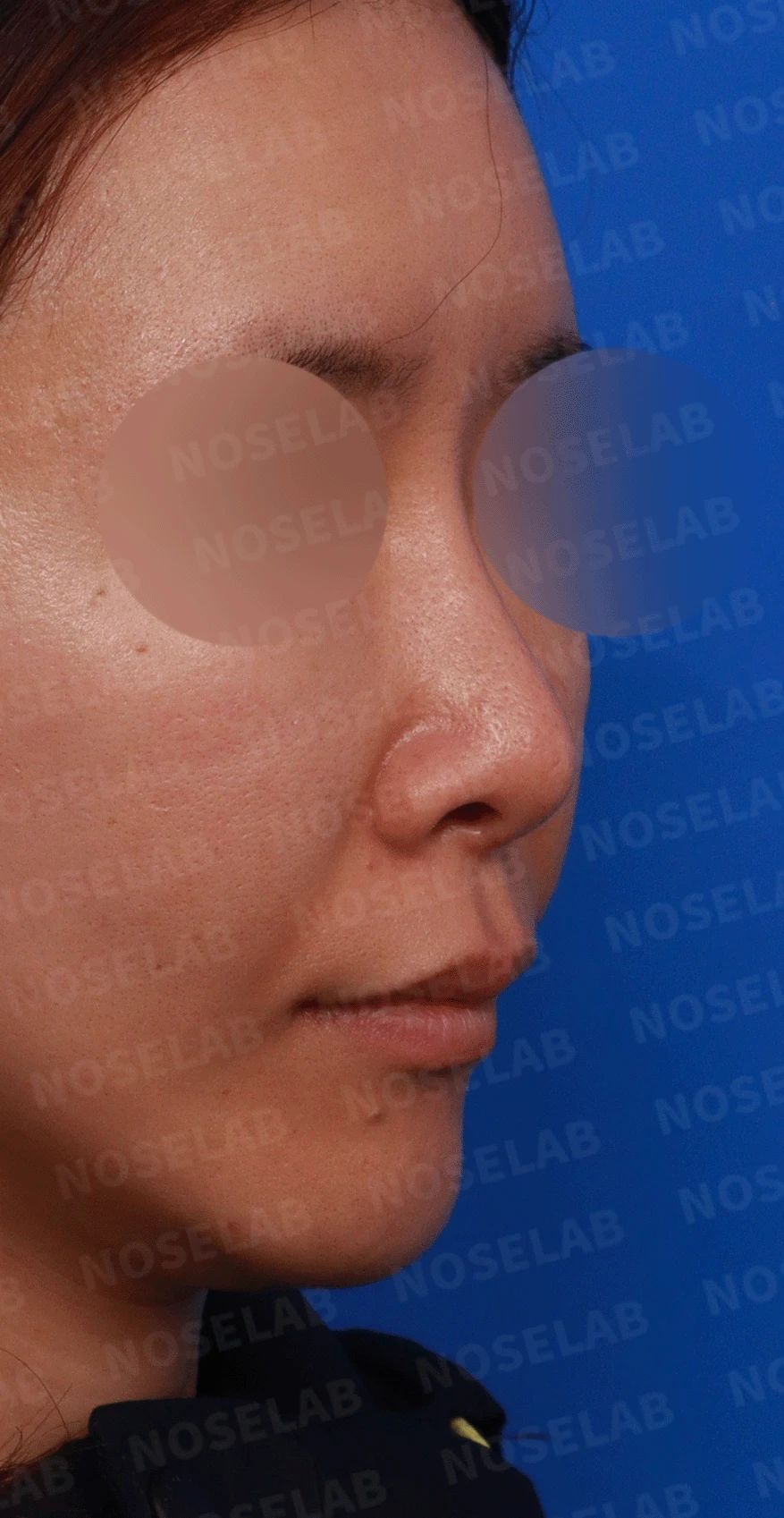 후비루와 코끝 처짐이 함께 나타나는 이유, 비중격 연장과 기능 수술은 어떻게 하나 — 디자인 상담 우측 측면 , 비스듬한 측면 , 비공 사진