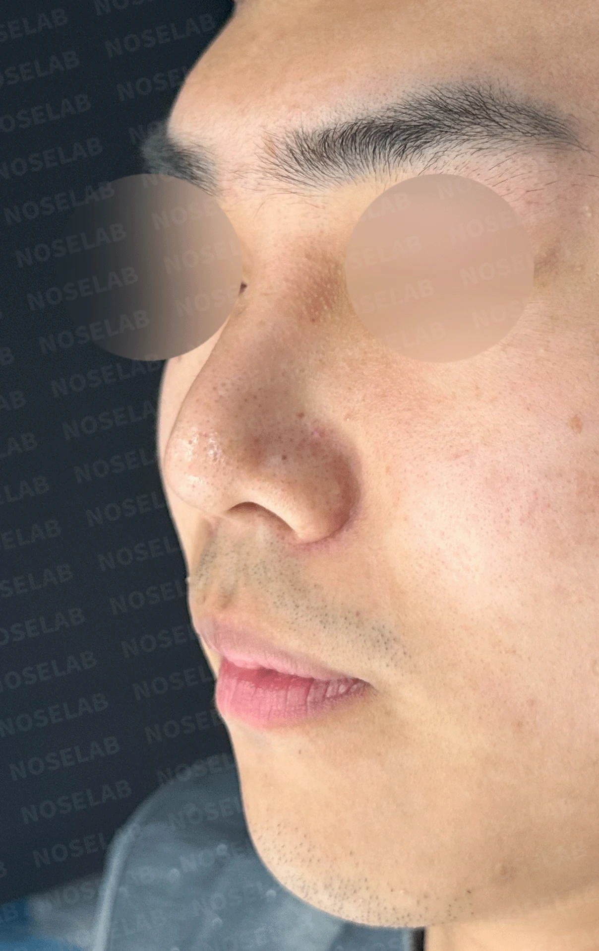 휜 코와 비공 노출 개선 - 자연스러운 코끝 상승 사례 — 본문 사진 11