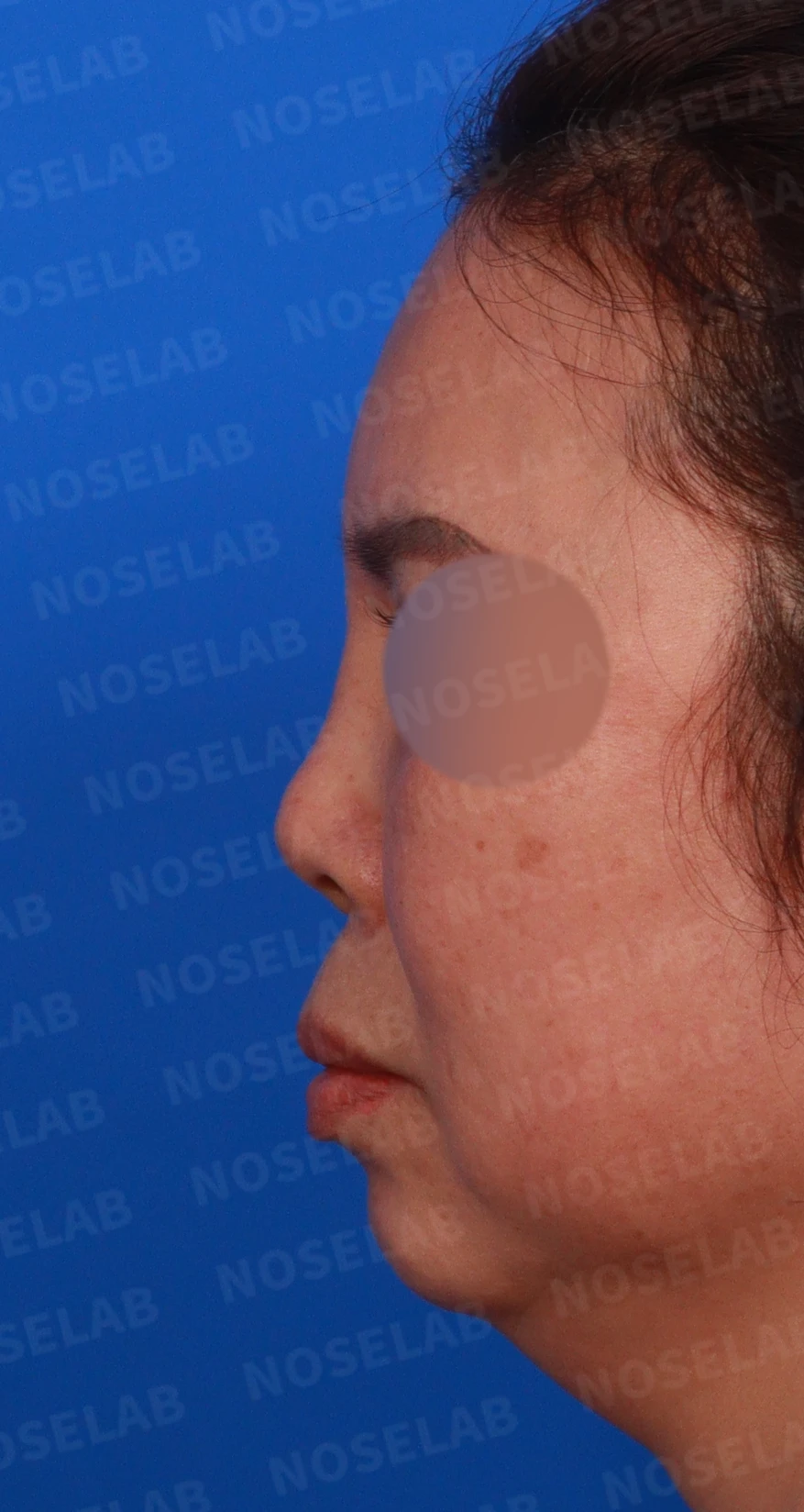 불법 주사 시술 뒤 코가 들리고 짧아지는 이유, 이물질 제거와 재건은 어떻게 하나 — 디자인 상담 정면, 좌측 측면, 비스듬한 측면 사진