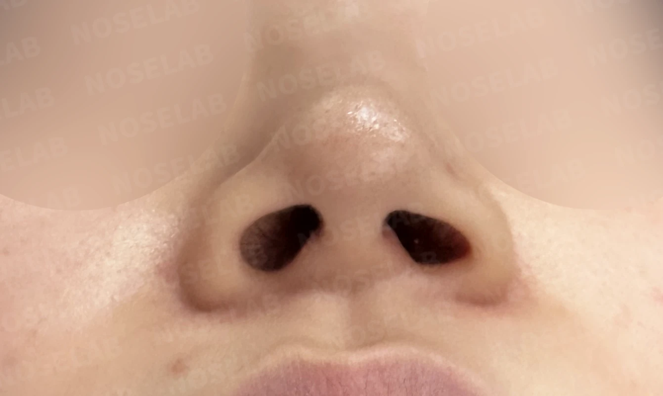 퍼진 코끝에 코막힘이 함께 오는 이유, 이물질 제거와 재건은 어떻게 하나 — 수술 전 / 수술 직후 0일 직후 사진은 부기가 있는 상태로 최종 결과와 다를 수 있습니다.