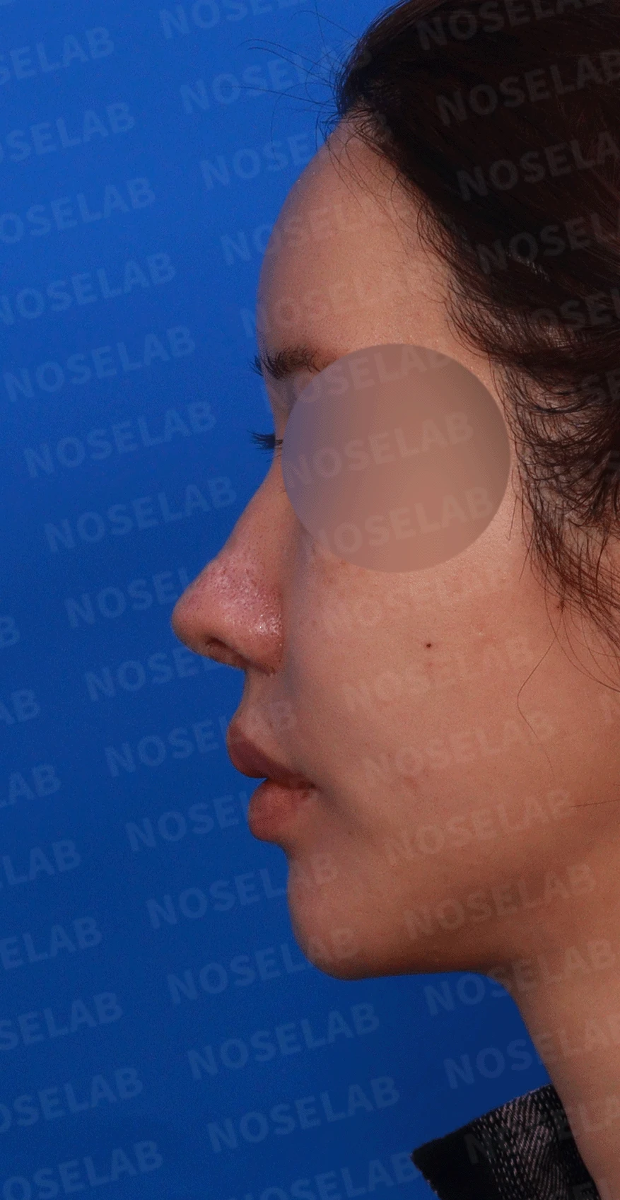 코 수술 뒤 콧등 피부가 괴사하면 어떤 변화가 남고, 재건은 어떻게 하나 — 디자인 상담 비스듬한 측면 , 좌측 측면, 비공 사진