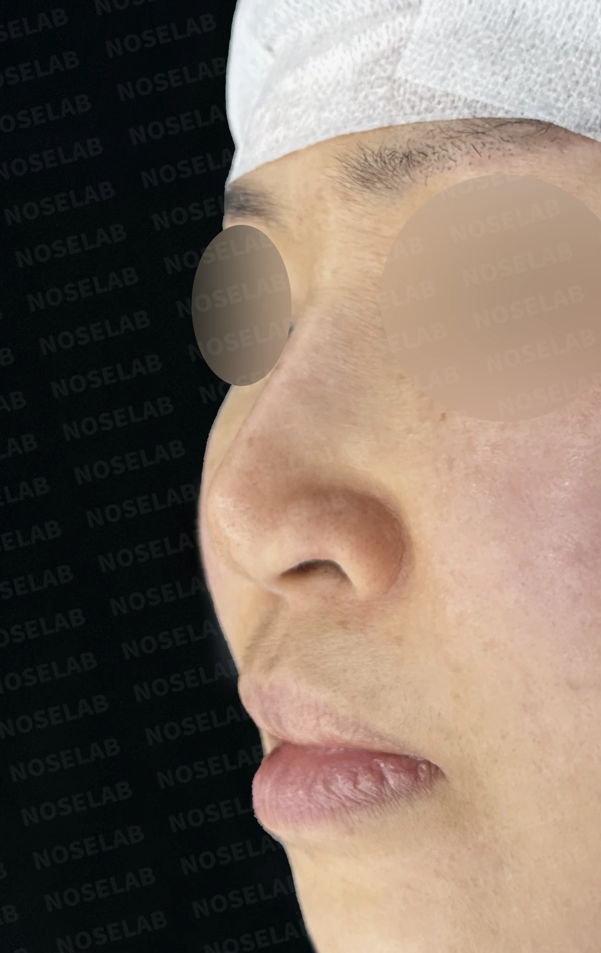 보형물 비침과 용코, 자가늑연골로 안전하게 교정한 코재수술 — 전(좌) 직후(후)