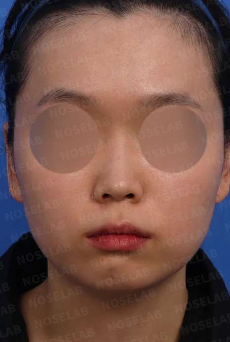 짧은 코의 비개방 교정 방법과 얼굴 비율 — 수술전 디자인 상담 정면 사진입니다.