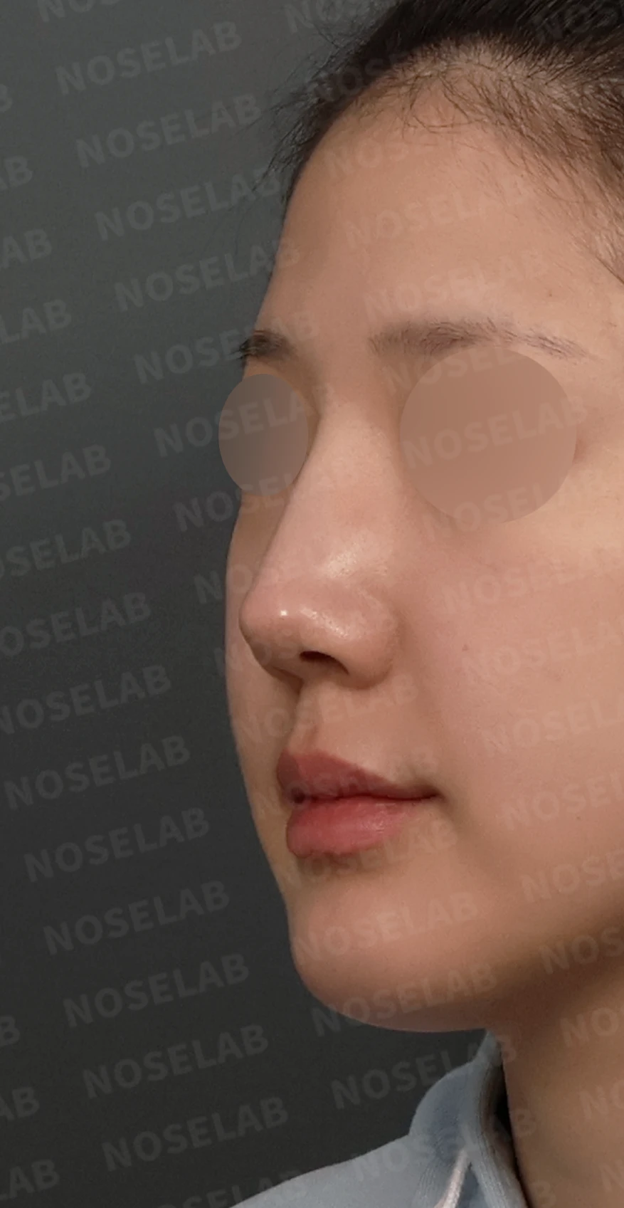 코재수술, 휘어진 코뼈와 매부리코를 외측 절골술과 자가늑연골로 자연스럽게 교정 — 디자인 상담 정면, 좌측 측면, 비스듬한 측면 사진입니다.