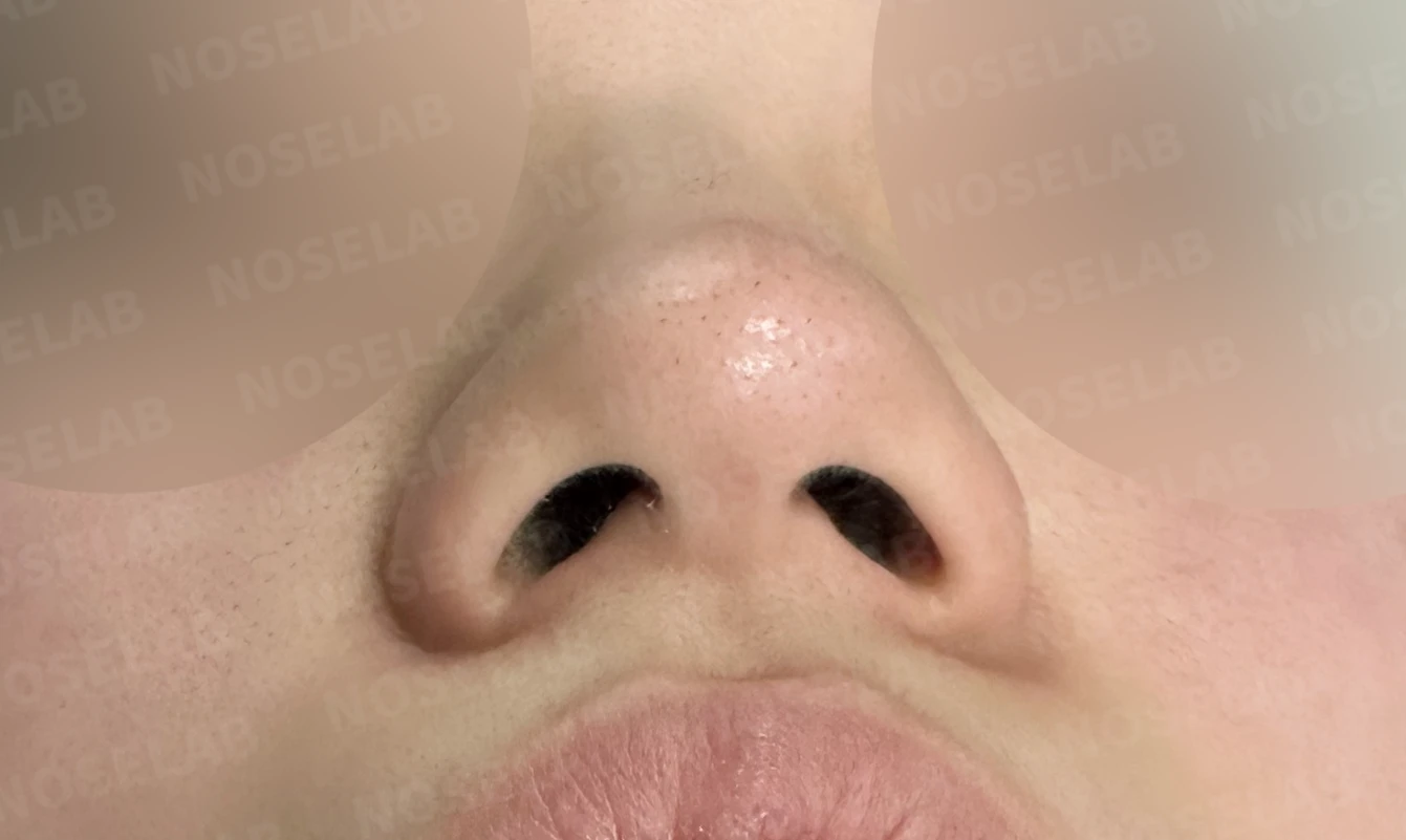 복코와 주먹코, 자가늑연골로 얄쌍하고 여성스러운 코 완성 — 전(좌) 직후(후)