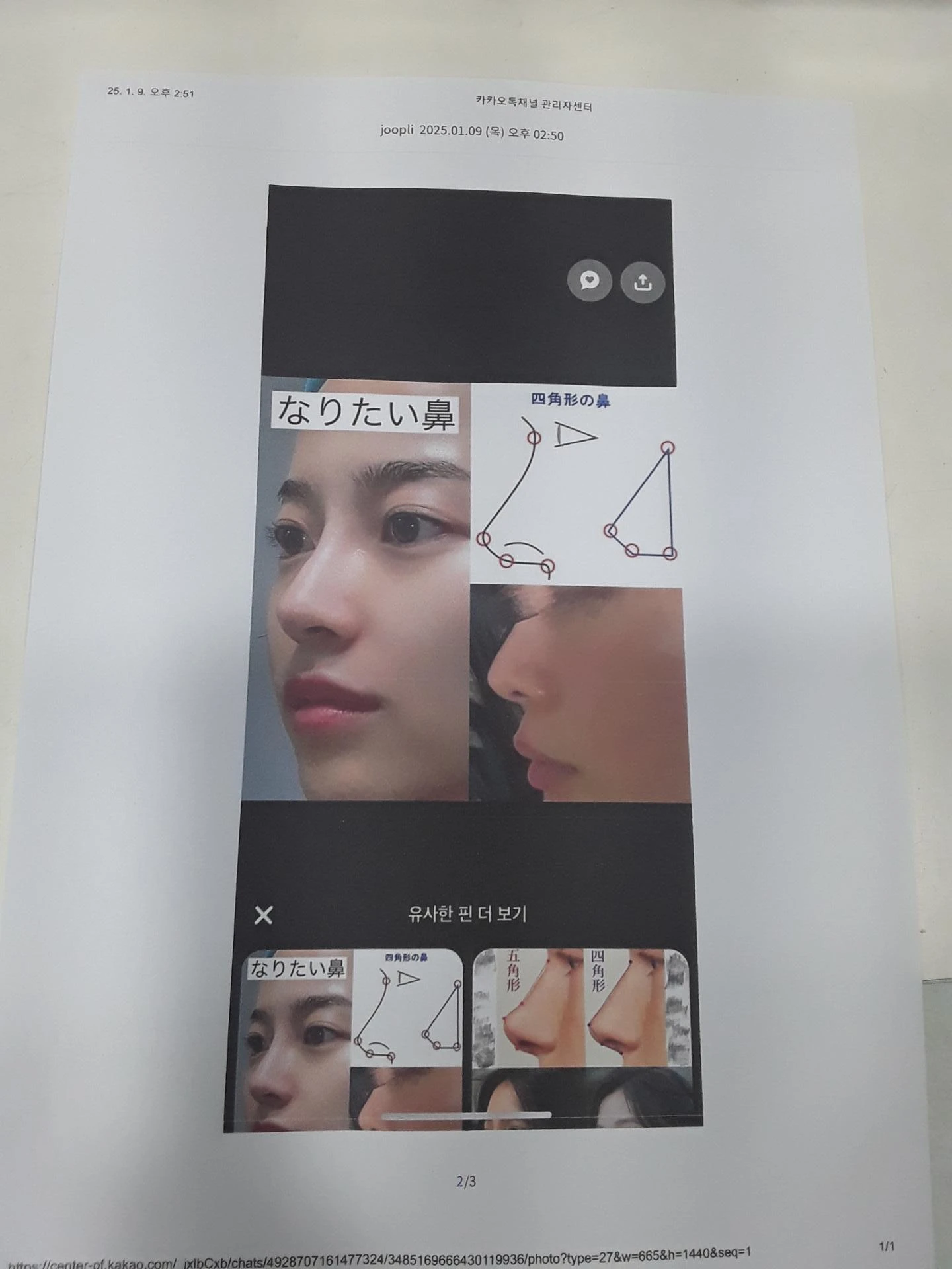 메드포어 점막 돌출로 인한 염증 코 - 자가늑연골 재건 수술 후기 — 환자분 원하시는 이미지 사진들