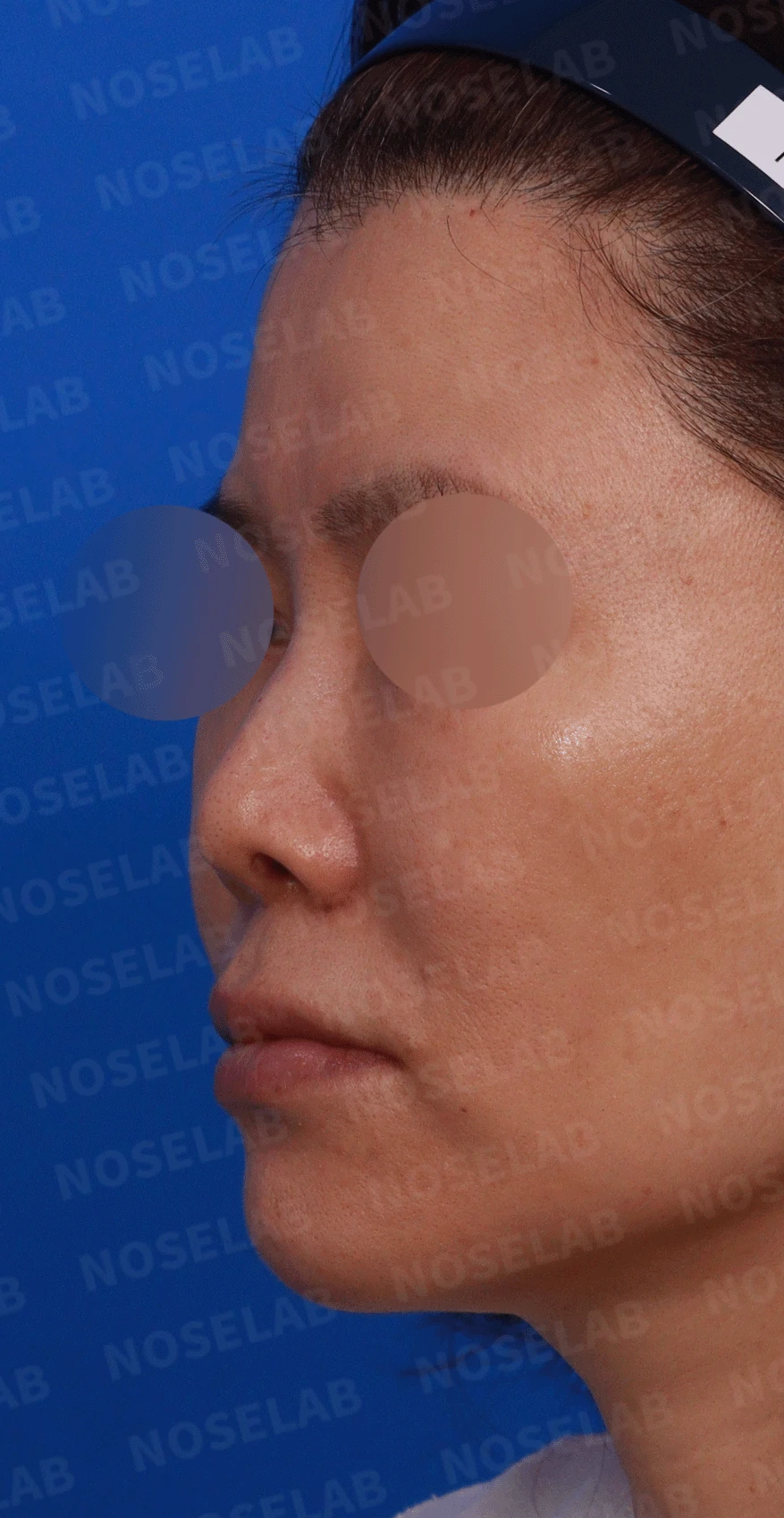 오래된 실리콘이 코끝에서 비쳐 보이는 이유와 제거·재건 방법 — 디자인 상담 정면, 좌측 측면, 비스듬한 측면 사진