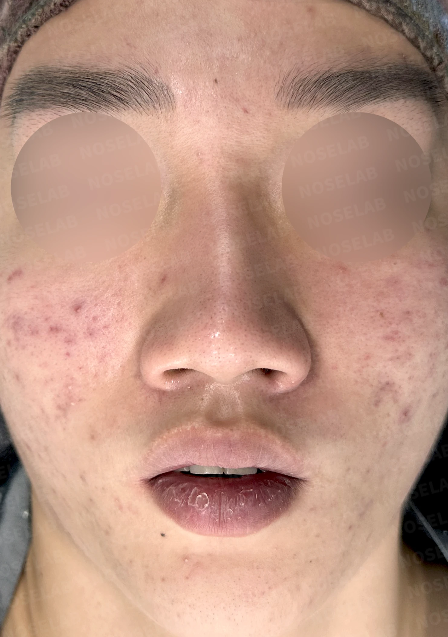 휜코 매부리코 교정, 남자 코성형으로 자연스러운 변화 — 전(좌) 직후(후)