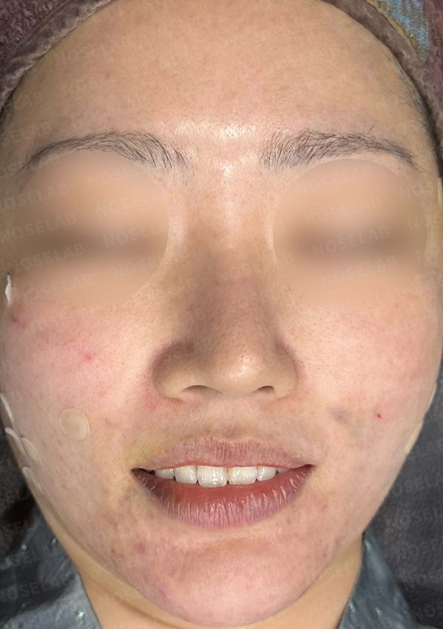 재수술한 코가 휘어 보이고 코끝이 처지는 이유 — 수술 전 / 수술 직후 0일 직후 사진은 부기가 있는 상태로 최종 결과와 다를 수 있습니다.