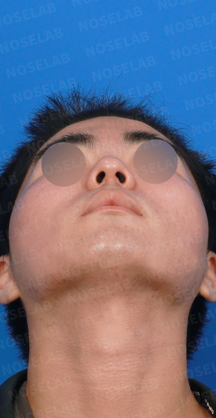 짧고 들려 보이는 작은 코, 왜 무리하게 높이지 않는가 — 디자인 상담 우측 측면, 비스듬한 측면, 비공 사진입니다.