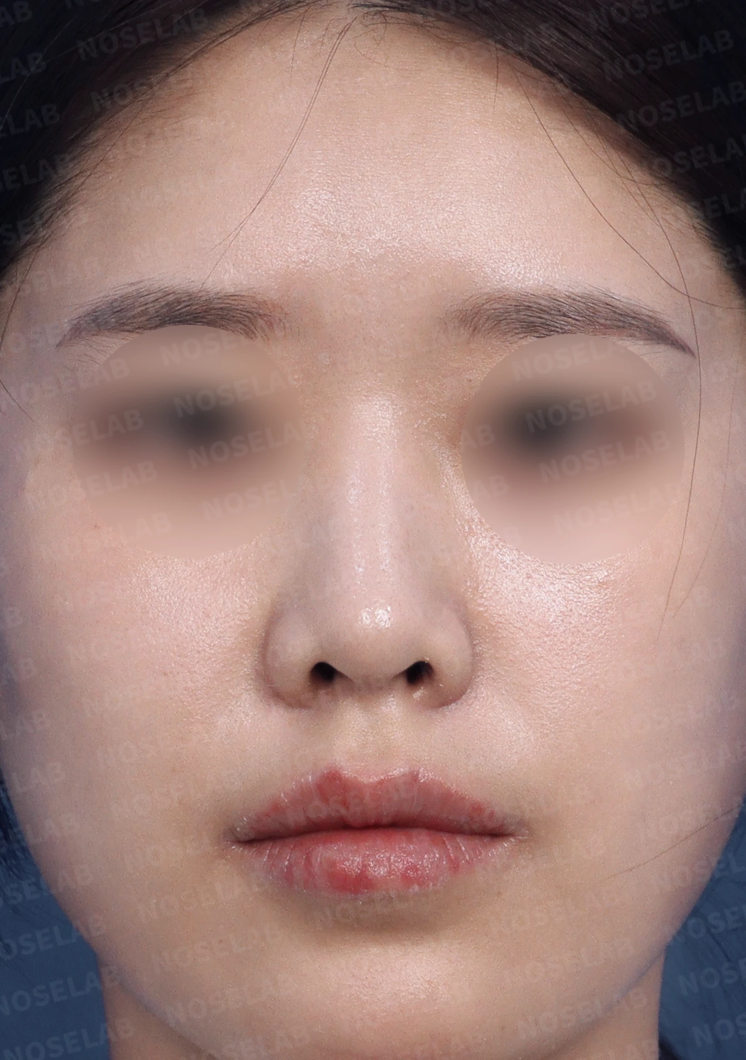 돌출입과 비순각을 함께 살펴보는 코성형 계획 — 수술 전 / 수술 직후 0일 직후 사진은 부기가 있는 상태로 최종 결과와 다를 수 있습니다.