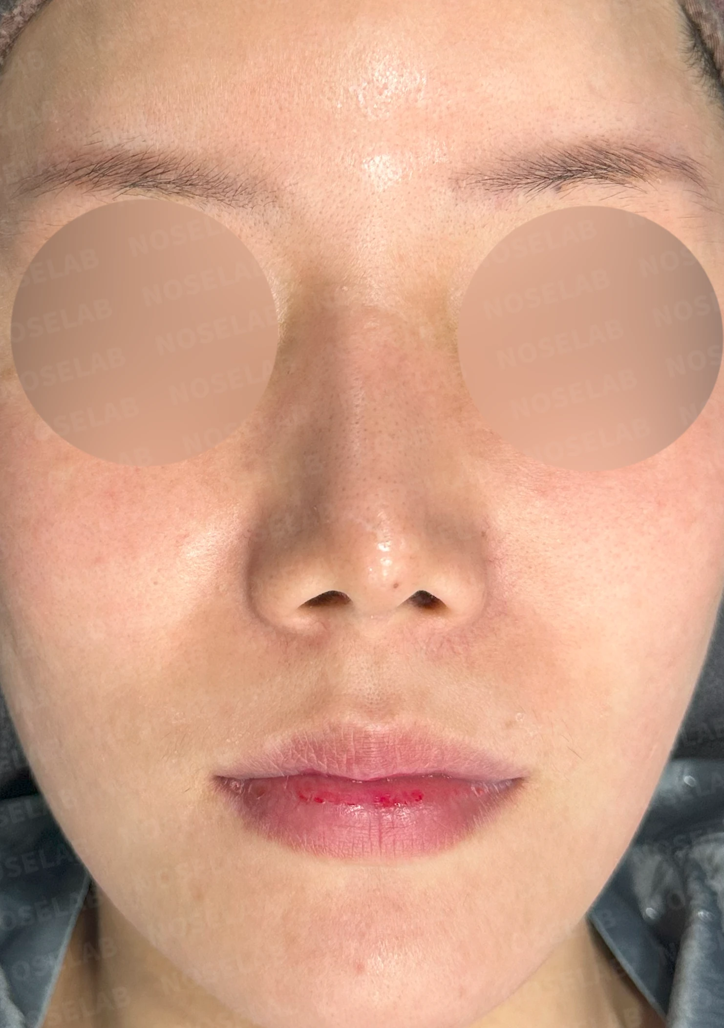 기증 늑연골이 흡수되면 코가 어떻게 변하고, 자가 늑연골 재건은 어떻게 하나 — 수술 전 / 수술 직후 0일 직후 사진은 부기가 있는 상태로 최종 결과와 다를 수 있습니다.