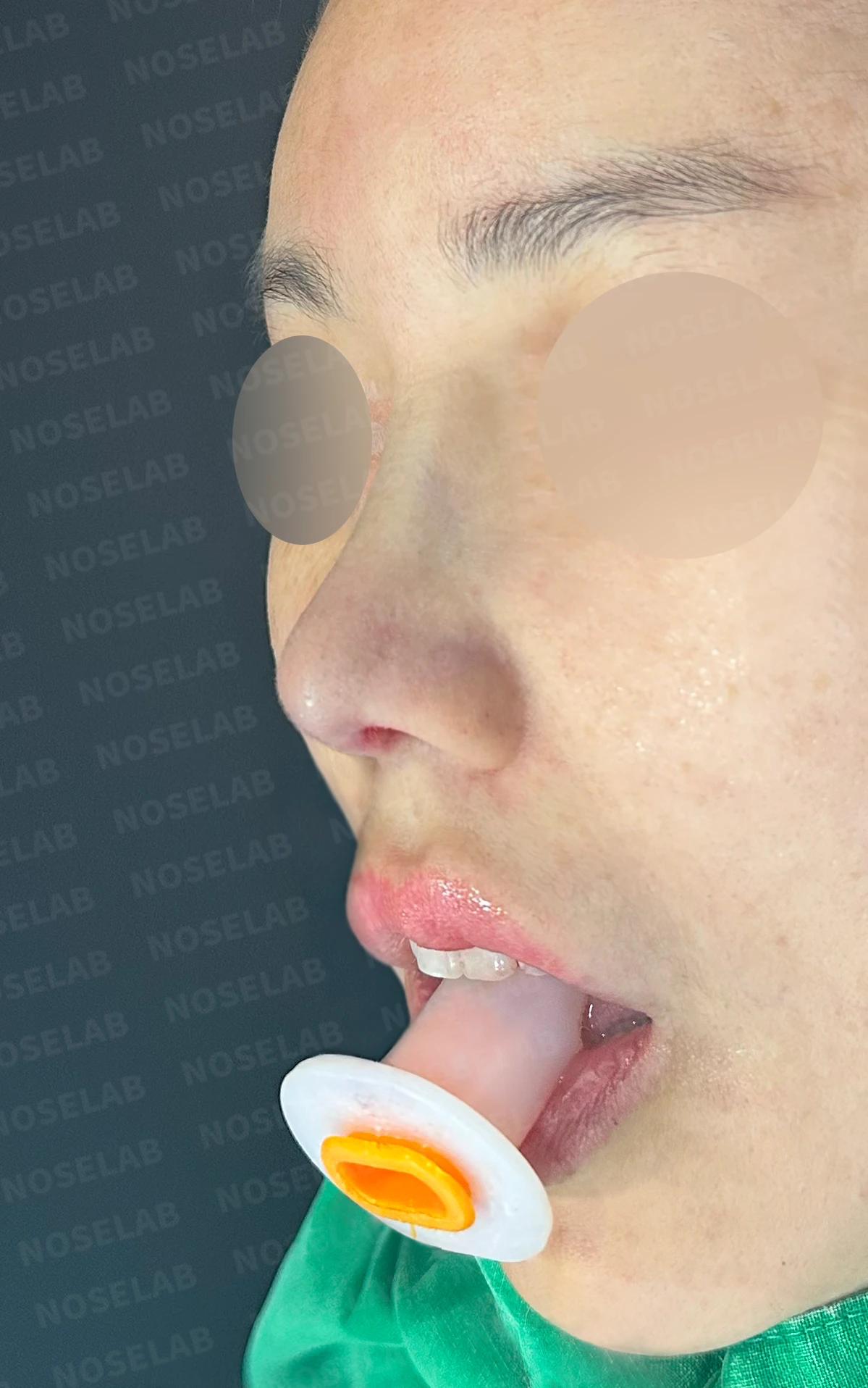 메드포어를 넣은 코에 코막힘이 생기는 이유, 제거와 자가늑연골 비중격 재건은 어떻게 하나 — 수술 직후 0일 정면, 비스듬한 측면, 측면 사진입니다. 직후 사진은 부기가 있는 상태로 최종 결과와 다를 수 있습니다.