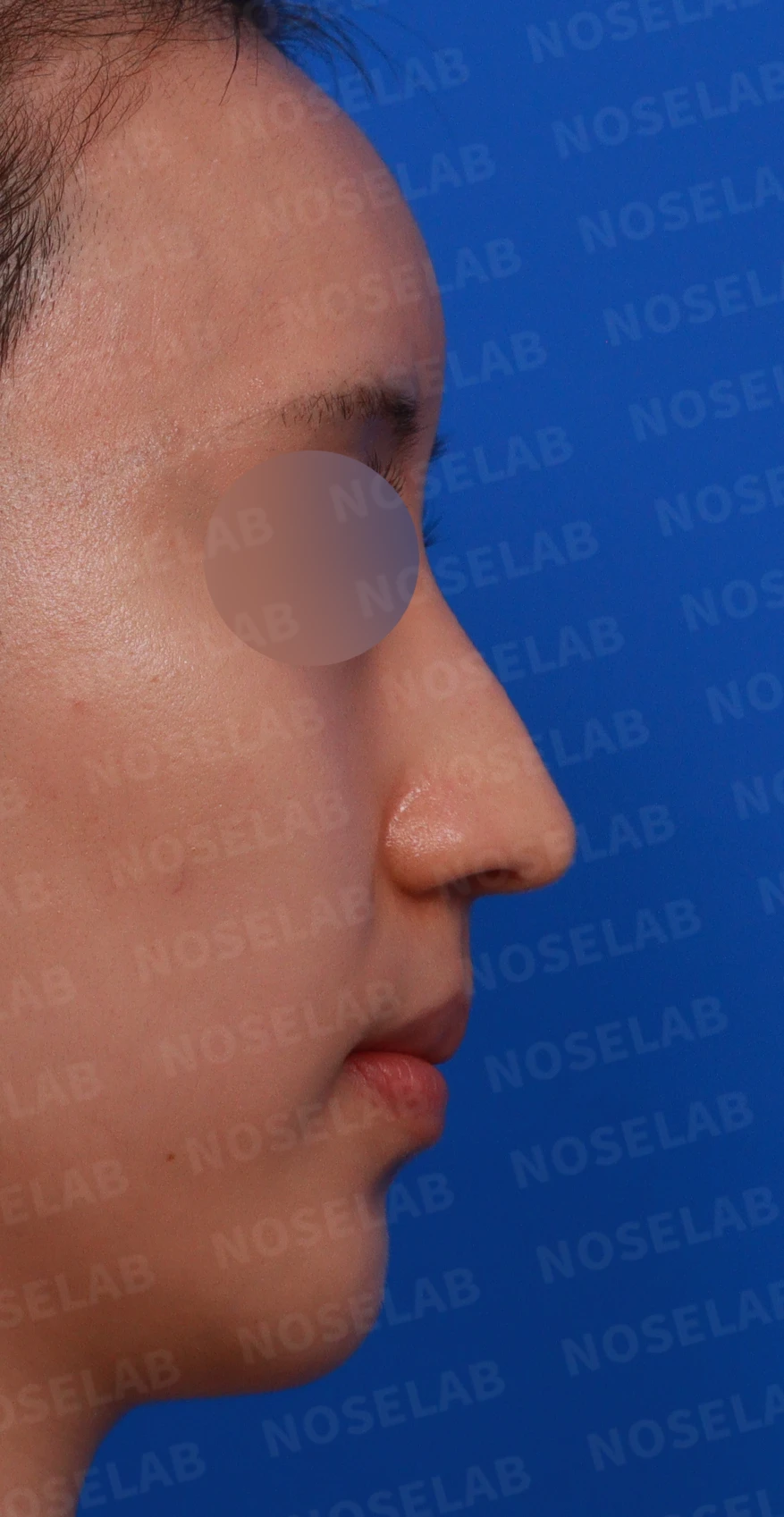 매부리코와 긴 코에 코막힘이 겹치는 이유, 교정은 어떻게 하나 — 디자인 상담 우측 비스듬한 측면, 측면, 비공 사진입니다.