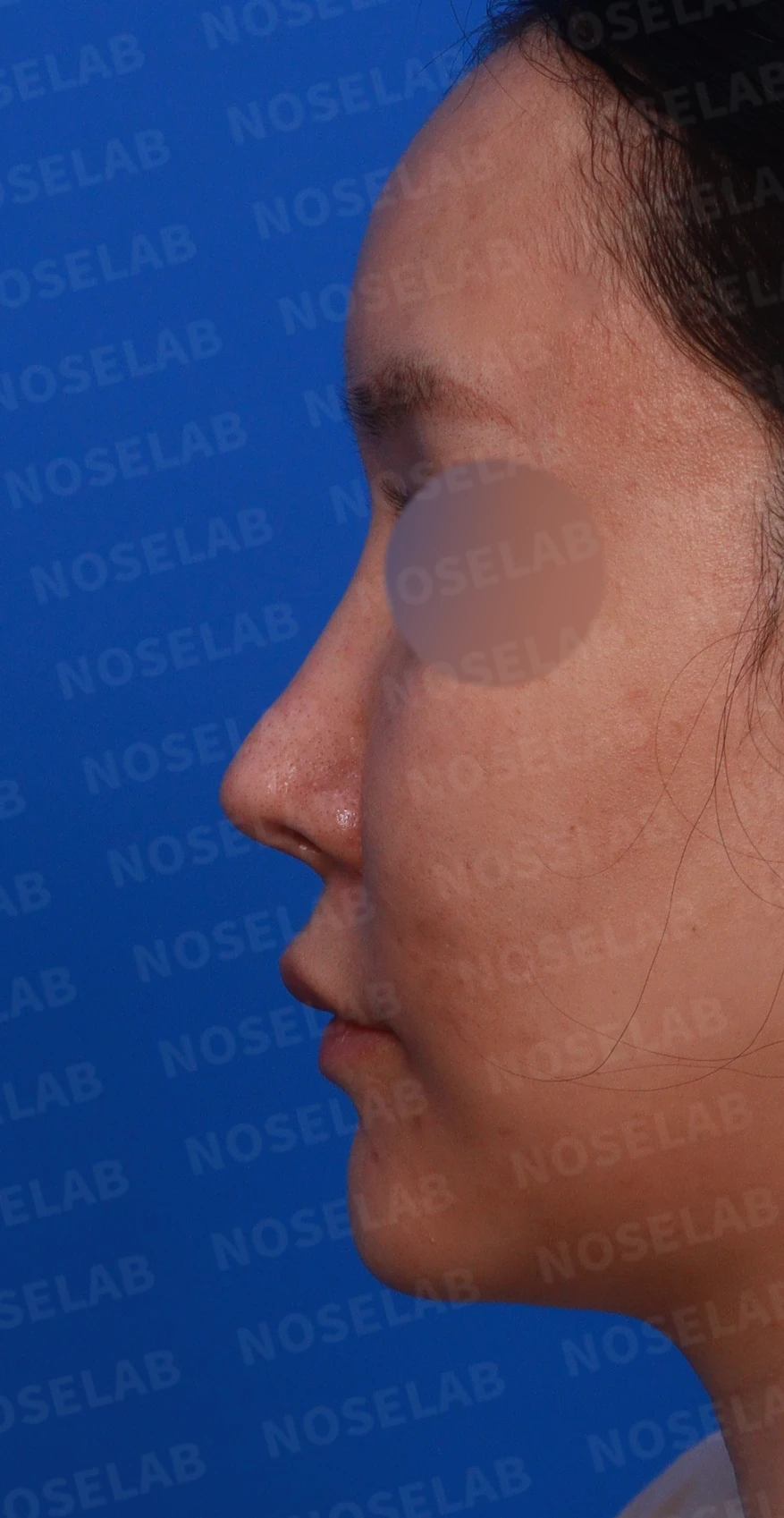 흡수된 기증늑연골을 자가늑연골로 교체 사례 — 디자인 상담 정면, 좌측 측면, 비스듬한 측면 사진